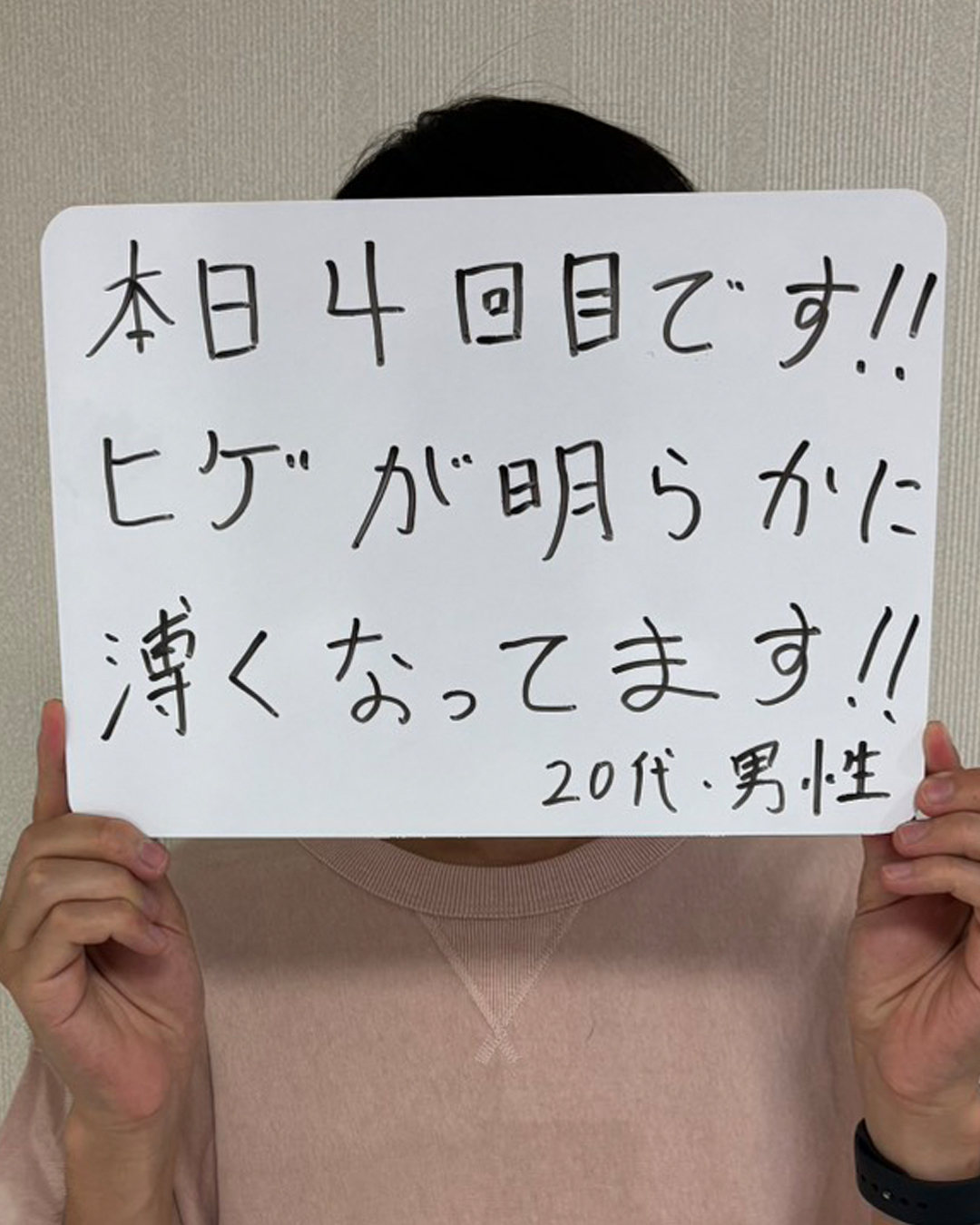 ヒゲ脱毛4回目の20代男性のお客様の声。「ヒゲが明らかに薄くなってます」と書かれた手書きの口コミ写真
